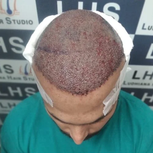 Best Hair Transplant Solutions